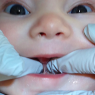 Tongue tie in newborns