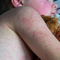 Measles cases reported King County