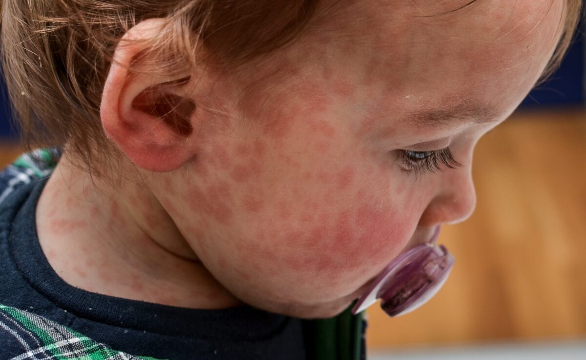 measles case in King County