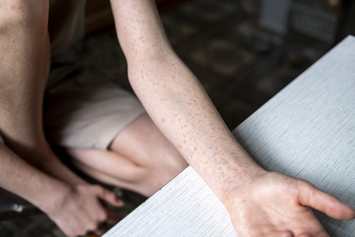 Measles rash in an adult.