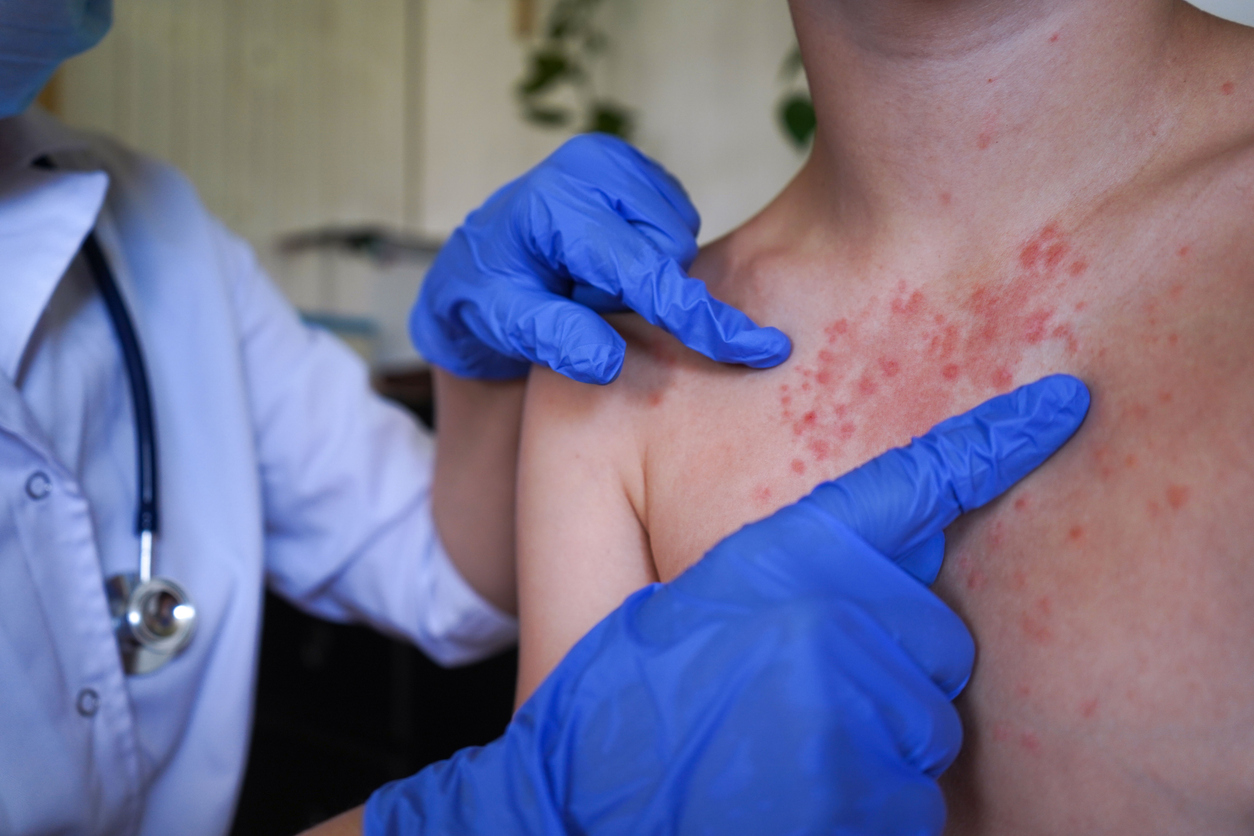 measles outbreak Snohomish County